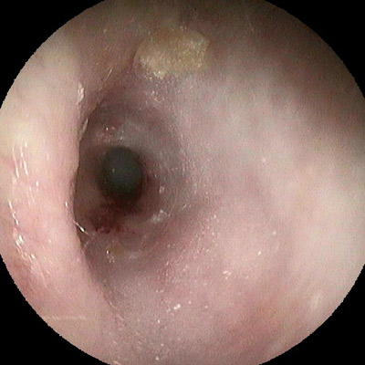 Lochblendenstenose des äußeren Gehörgangs durch Bindegewebswucherungen